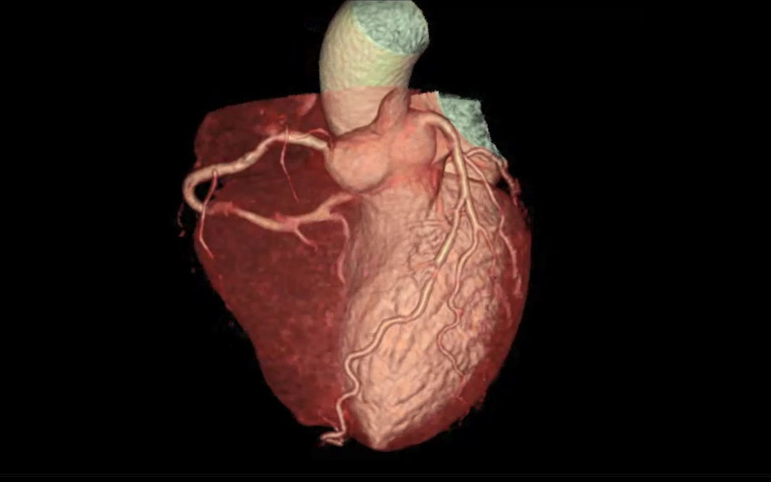 Hightech-Diagnostik und Therapie zur Herzinfarkt-Prävention – Artikel Sonntags Zeitung
